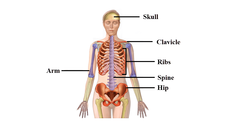 Common Sites of Bone Injury By Myeloma