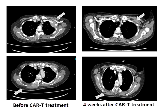 https://cartservice.org/uploads/sites/1032/comparison-ct-images-before-after-car-t-treatment.png